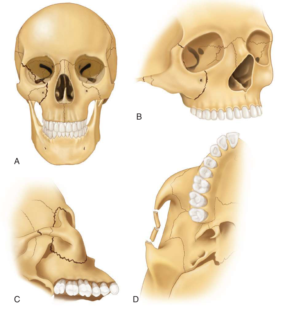 FIGURE 16-3 Common fracture pattern in ZMC injury. A, Frontal view of skull showing fracture medial to a zygomaticomaxillary suture and along a zygomaticosphenoid suture within orbit. B, Oblique frontal view of skull showing fractures through a frontozygomatic suture and posterior to a zygomaticotemporal suture. C, Temporal view of skull showing fractures extending from the inferior orbital fissure superiorly through the zygomaticosphenoid suture and inferiorly through the zygomatic buttress of the maxilla. D, Inferior skull showing a triple fracture through the zygomatic arch. Note that the orbital floor, medial orbital wall, and zygomaticomaxillary buttress are frequently comminuted in add