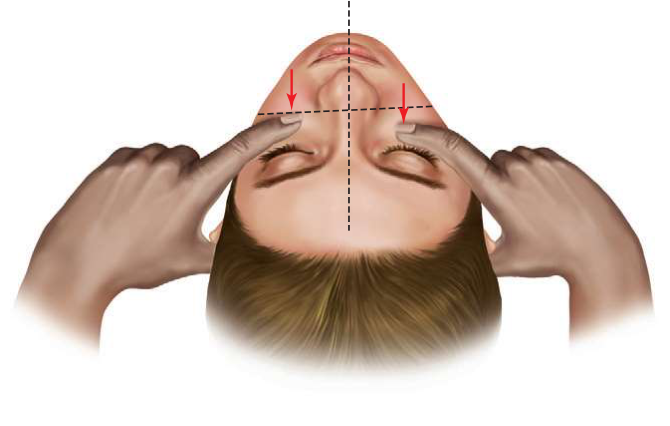 FIGURE 16-4 Method of assessing posterior displacement of the ZMC from behind the patient. The clinician should firmly depress the fingers into the edematous soft tissue while palpating along infraorbital areas.