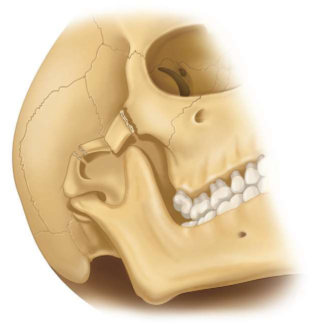 FIGURE 16-5 Depressed zygomatic arch impinging on the temporal muscle and/or coronoid process, limiting mandibular excursions.