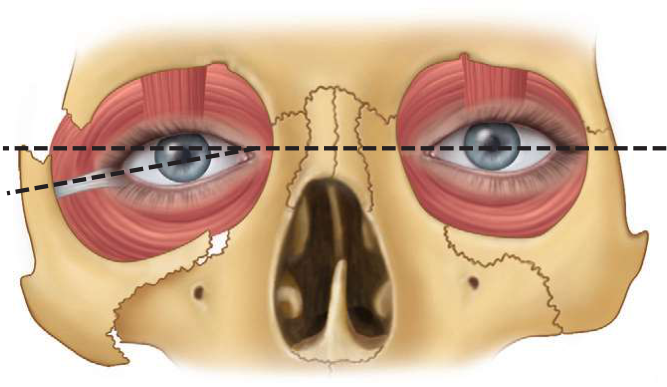 FIGURE 16-7 Inferior displacement of the zygoma results in depression of the lateral canthus and pupil because of depression of the suspensory ligaments that attach to the lateral orbital (Whitnall’s) tubercle.