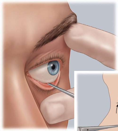 FIGURE 16-8 The forced duction test determines whether there is a physical impediment to ocular motility. A, Grasping of the inferior rectus muscle. B, Clinical photograph. (From Ward Booth P, Eppley BL, Schmelzeisen R: Maxillofacial trauma and esthetic facial reconstruction, ed 2, WB Saunders, St. Louis, 2012.)