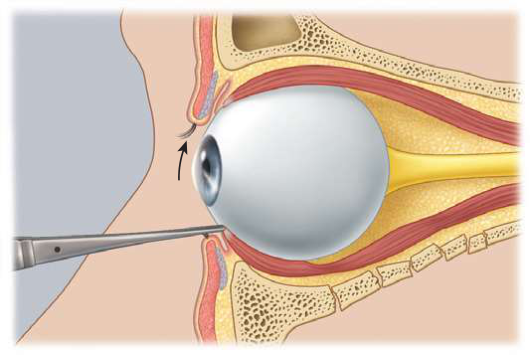 FIGURE 16-8 The forced duction test determines whether there is a physical impediment to ocular motility. A, Grasping of the inferior rectus muscle. B, Clinical photograph. (From Ward Booth P, Eppley BL, Schmelzeisen R: Maxillofacial trauma and esthetic facial reconstruction, ed 2, WB Saunders, St. Louis, 2012.)