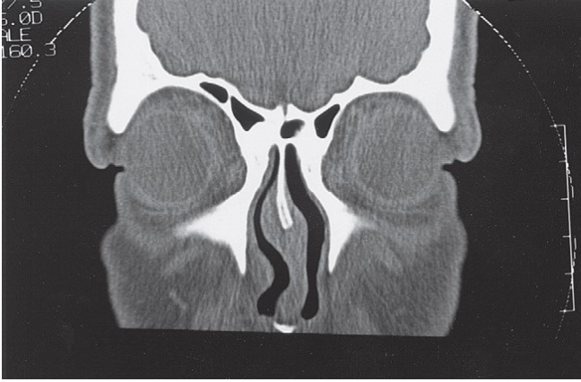 FIGURE 16-9 A - D, CT scans showing exquisite detail of a patient without a ZMC fracture demonstrating normal anatomy. A, Coronal CT scan through the medial orbital rim. One should be alert to the possibility of fractures in this area. If lateral displacement of the medial orbital rim goes unnoticed, proper alignment of the infraorbital rim will cause the ZMC to be laterally displaced. B, Coronal CT scan just posterior to the globe. The coronal scan is particularly useful for assessing the status of the medial wall and floor of the orbit. One should carefully compare the size of the orbits and the contour of the floor and walls. The coronal scan is also extremely useful for assessing the pos