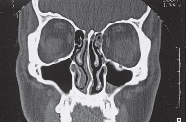 FIGURE 16-9 A - D, CT scans showing exquisite detail of a patient without a ZMC fracture demonstrating normal anatomy. A, Coronal CT scan through the medial orbital rim. One should be alert to the possibility of fractures in this area. If lateral displacement of the medial orbital rim goes unnoticed, proper alignment of the infraorbital rim will cause the ZMC to be laterally displaced. B, Coronal CT scan just posterior to the globe. The coronal scan is particularly useful for assessing the status of the medial wall and floor of the orbit. One should carefully compare the size of the orbits and the contour of the floor and walls. The coronal scan is also extremely useful for assessing the pos