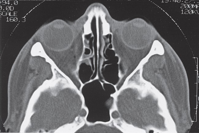 FIGURE 16-9 A - D, CT scans showing exquisite detail of a patient without a ZMC fracture demonstrating normal anatomy. A, Coronal CT scan through the medial orbital rim. One should be alert to the possibility of fractures in this area. If lateral displacement of the medial orbital rim goes unnoticed, proper alignment of the infraorbital rim will cause the ZMC to be laterally displaced. B, Coronal CT scan just posterior to the globe. The coronal scan is particularly useful for assessing the status of the medial wall and floor of the orbit. One should carefully compare the size of the orbits and the contour of the floor and walls. The coronal scan is also extremely useful for assessing the pos