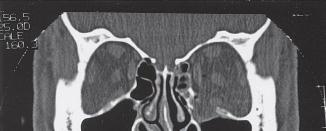 FIGURE 16-9 A - D, CT scans showing exquisite detail of a patient without a ZMC fracture demonstrating normal anatomy. A, Coronal CT scan through the medial orbital rim. One should be alert to the possibility of fractures in this area. If lateral displacement of the medial orbital rim goes unnoticed, proper alignment of the infraorbital rim will cause the ZMC to be laterally displaced. B, Coronal CT scan just posterior to the globe. The coronal scan is particularly useful for assessing the status of the medial wall and floor of the orbit. One should carefully compare the size of the orbits and the contour of the floor and walls. The coronal scan is also extremely useful for assessing the pos