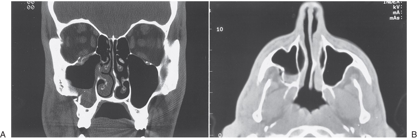 FIGURE 16-10 CT scans of a low-energy ZMC fracture. A, Coronal scan shows rotation of the ZMC around the zygomaticofrontal suture downward and medially into the maxillary sinus. Note the difference in the position of the malar eminence from one side to the other and the disruption and displacement of the zygomaticomaxillary buttress. However, note that the fracture through the orbital floor is noncomminuted. B, Axial scan of the same patient shows posterior displacement of the malar eminence and rotation of the posterior (infratemporal) surface of the ZMC medially into the maxillary sinus. This fracture was treated by open reduction via an intraoral approach and fixation with a single bone p