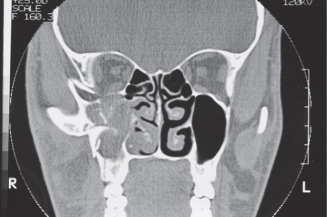 FIGURE 16-10 CT scans of a low-energy ZMC fracture. A, Coronal scan shows rotation of the ZMC around the zygomaticofrontal suture downward and medially into the maxillary sinus. Note the difference in the position of the malar eminence from one side to the other and the disruption and displacement of the zygomaticomaxillary buttress. However, note that the fracture through the orbital floor is noncomminuted. B, Axial scan of the same patient shows posterior displacement of the malar eminence and rotation of the posterior (infratemporal) surface of the ZMC medially into the maxillary sinus. This fracture was treated by open reduction via an intraoral approach and fixation with a single bone p