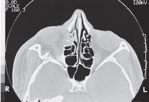 FIGURE 16-10 CT scans of a low-energy ZMC fracture. A, Coronal scan shows rotation of the ZMC around the zygomaticofrontal suture downward and medially into the maxillary sinus. Note the difference in the position of the malar eminence from one side to the other and the disruption and displacement of the zygomaticomaxillary buttress. However, note that the fracture through the orbital floor is noncomminuted. B, Axial scan of the same patient shows posterior displacement of the malar eminence and rotation of the posterior (infratemporal) surface of the ZMC medially into the maxillary sinus. This fracture was treated by open reduction via an intraoral approach and fixation with a single bone p