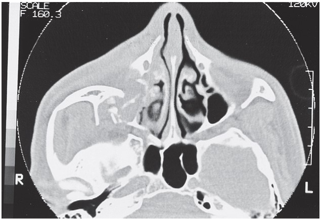 FIGURE 16-11 CT scans of a high-energy ZMC fracture. A, Coronal scan of the posterior orbit showing disruption of the orbital floor and lateral wall. Note also the comminution of the malar eminence and zygomaticomaxillary buttress. B, Axial scan at the level of the midglobe showing comminution of the lateral orbital wall (sphenozygomatic suture) and notable posterior displacement of the lateral orbital rim. C, Axial scan at the level of the zygomatic arch showing severe displacement of the malar eminence posteriorly into maxillary sinus. Note also the degree of comminution and bowing of the zygomatic arch. D, Axial scan at the level of the malar eminence showing severe posterior and medial d