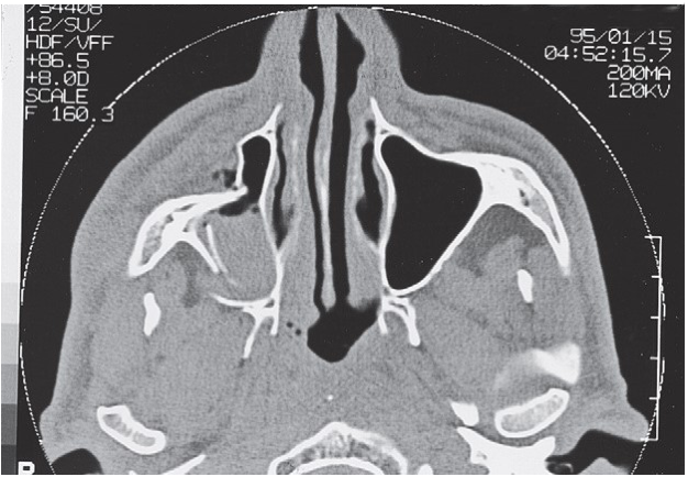 FIGURE 16-11 CT scans of a high-energy ZMC fracture. A, Coronal scan of the posterior orbit showing disruption of the orbital floor and lateral wall. Note also the comminution of the malar eminence and zygomaticomaxillary buttress. B, Axial scan at the level of the midglobe showing comminution of the lateral orbital wall (sphenozygomatic suture) and notable posterior displacement of the lateral orbital rim. C, Axial scan at the level of the zygomatic arch showing severe displacement of the malar eminence posteriorly into maxillary sinus. Note also the degree of comminution and bowing of the zygomatic arch. D, Axial scan at the level of the malar eminence showing severe posterior and medial d