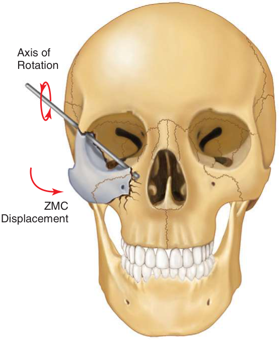 FIGURE 16-12 The ZMC can rotate inferiorly and medially, even when reduced at the frontozygomatic and infraorbital areas.