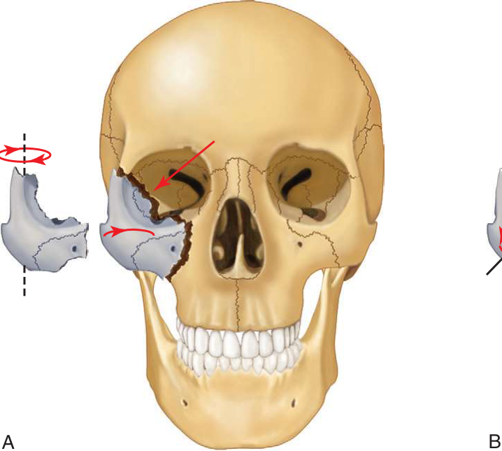 FIGURE 16-13 Anatomic areas for determining the proper reduction of ZMC fracture. A, Rotation of the ZMC in the vertical axis is most easily determined by its alignment with the greater wing of the sphenoid along the internal orbit (straight arrow). B, The zygomaticomaxillary buttress provides a sensitive indicator of malar projection.