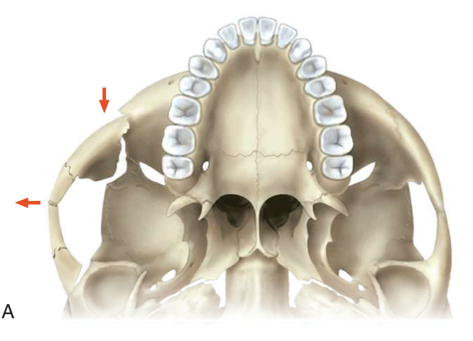 FIGURE 16-14 A, The reciprocal relationship between facial width and malar projection is demonstrated. Note that the normal contour of the zygomatic arch is straight, not curved. If the zygomatic arch is reconstructed with a bow, the malar eminence will lack anterior projection. Frontal (B) and submental (C) views of a patient who had open reduction and internal fixation of a right ZMC fracture 2 years previously. Note the increase in facial width and the decrease in malar projection. Also note the enophthalmos of the right globe. D, Axial CT scan showing lateral bowing of the zygomatic arch and the posterior position of the frontal process of the zygoma. One can see that the medial orbital 