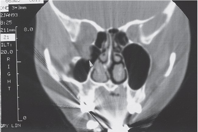 FIGURE 16-14 A, The reciprocal relationship between facial width and malar projection is demonstrated. Note that the normal contour of the zygomatic arch is straight, not curved. If the zygomatic arch is reconstructed with a bow, the malar eminence will lack anterior projection. Frontal (B) and submental (C) views of a patient who had open reduction and internal fixation of a right ZMC fracture 2 years previously. Note the increase in facial width and the decrease in malar projection. Also note the enophthalmos of the right globe. D, Axial CT scan showing lateral bowing of the zygomatic arch and the posterior position of the frontal process of the zygoma. One can see that the medial orbital 