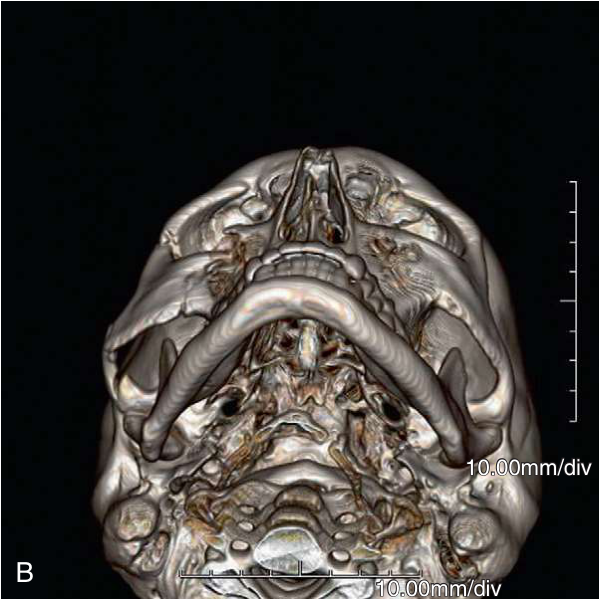 FIGURE 16-16 Use of intraoperative CT scanning. A, B, Preoperative three-dimensional CT scans show a moderately displaced right ZMC fracture. Note the lateral displacement of zygomatic arch and posterior displacement of malar eminence. C, D, Preoperative coronal CT scans show fractures of the orbital floor.