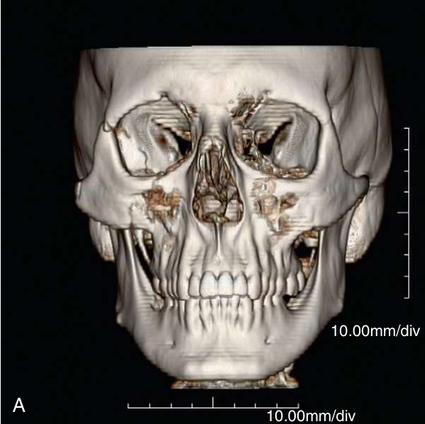 FIGURE 16-16 Use of intraoperative CT scanning. A, B, Preoperative three-dimensional CT scans show a moderately displaced right ZMC fracture. Note the lateral displacement of zygomatic arch and posterior displacement of malar eminence. C, D, Preoperative coronal CT scans show fractures of the orbital floor.
