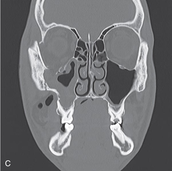 FIGURE 16-16 Use of intraoperative CT scanning. A, B, Preoperative three-dimensional CT scans show a moderately displaced right ZMC fracture. Note the lateral displacement of zygomatic arch and posterior displacement of malar eminence. C, D, Preoperative coronal CT scans show fractures of the orbital floor.