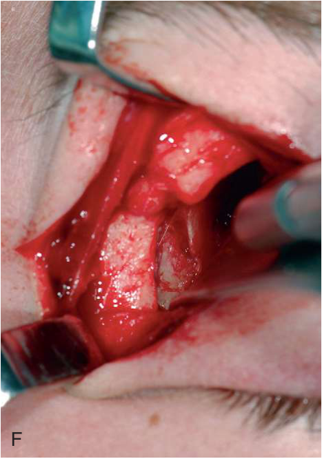 FIGURE 16-16, cont’d The ZMC fracture was exposed using maxillary vestibular (E) and upper eyelid approaches (F) . G, The ZMC was reduced using a Carroll-Girard screw. H, An intraoperative CT scan was then obtained to determine whether the reduction of the ZMC was adequate and to determine whether internal orbital reconstruction was necessary.