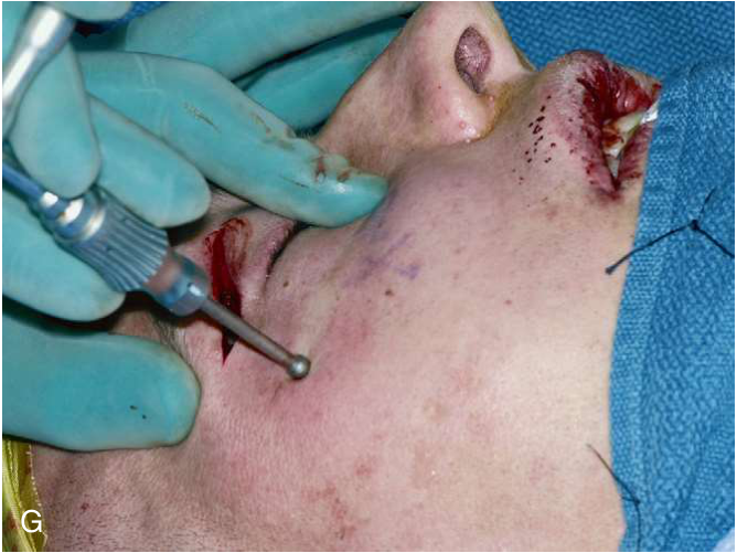 FIGURE 16-16, cont’d The ZMC fracture was exposed using maxillary vestibular (E) and upper eyelid approaches (F) . G, The ZMC was reduced using a Carroll-Girard screw. H, An intraoperative CT scan was then obtained to determine whether the reduction of the ZMC was adequate and to determine whether internal orbital reconstruction was necessary.