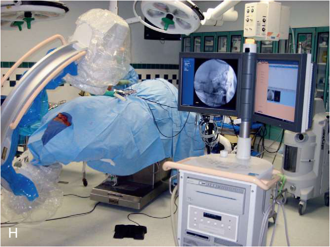 FIGURE 16-16, cont’d The ZMC fracture was exposed using maxillary vestibular (E) and upper eyelid approaches (F) . G, The ZMC was reduced using a Carroll-Girard screw. H, An intraoperative CT scan was then obtained to determine whether the reduction of the ZMC was adequate and to determine whether internal orbital reconstruction was necessary.