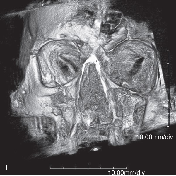 FIGURE 16-16, cont’d I, J, Intraoperative three-dimensional reconstructions demonstrated good reduction of the ZMC. Coronal (K) and sagittal (L) images of the orbit indicated that the orbital floor was in good position, so no internal orbital reconstruction was deemed necessary.