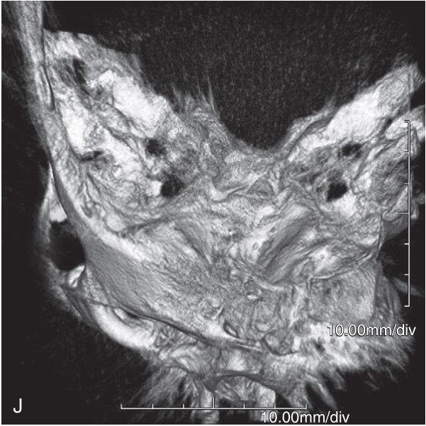 FIGURE 16-16, cont’d I, J, Intraoperative three-dimensional reconstructions demonstrated good reduction of the ZMC. Coronal (K) and sagittal (L) images of the orbit indicated that the orbital floor was in good position, so no internal orbital reconstruction was deemed necessary.