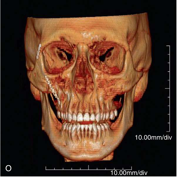 FIGURE 16-16, cont’d The ZMC was stabilized with bone plates across the zygomaticomaxillary buttress ( M ) and frontozyomatic suture areas ( N ) and the incisions closed. O, P, Q, Postoperative CT scans demonstrate good position of the ZMC and orbital floor ( R,S,T ).