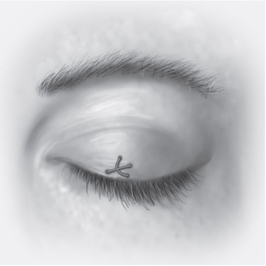 FIGURE 16-17 A, Scleral shell used for ocular protection. B, C, Technique of temporary tarsorrhaphy.