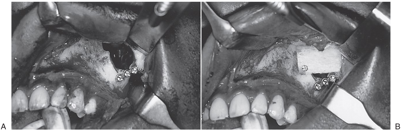 FIGURE 16-18 A, Anterior maxillary wall defect after reduction and fixation of a ZMC fracture. B, Bone graft placed over the area of defect.