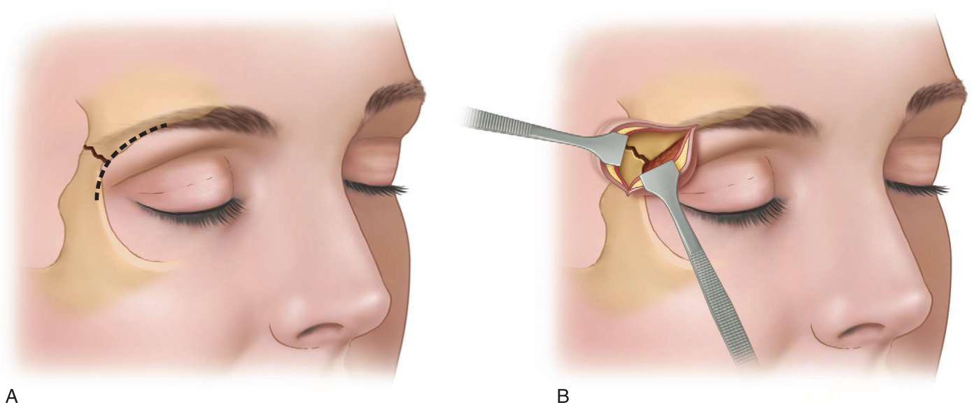 FIGURE 16-20 Supraorbital eyebrow approach to frontozygomatic suture. A, Most of incision is within the confines of the eyebrow. B, Exposure of the fracture.
