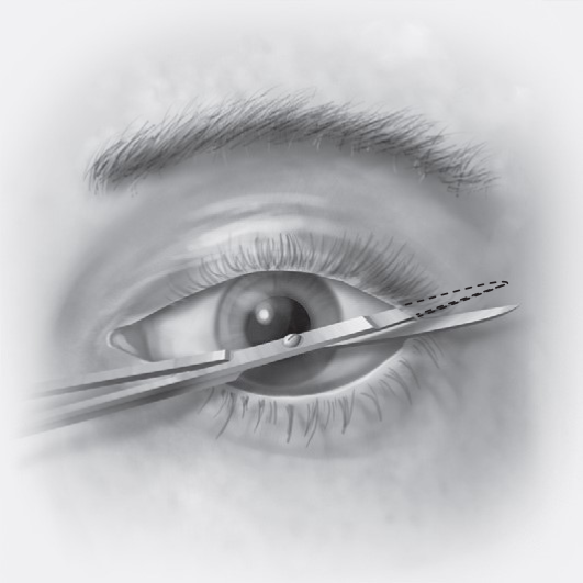 FIGURE 16-24 Transconjunctival incisions. A, Retroseptal approach. B, Preseptal approach. C, Initial full-thickness incision through the lateral canthus. D, Inferior cantholysis performed to release the lower eyelid.