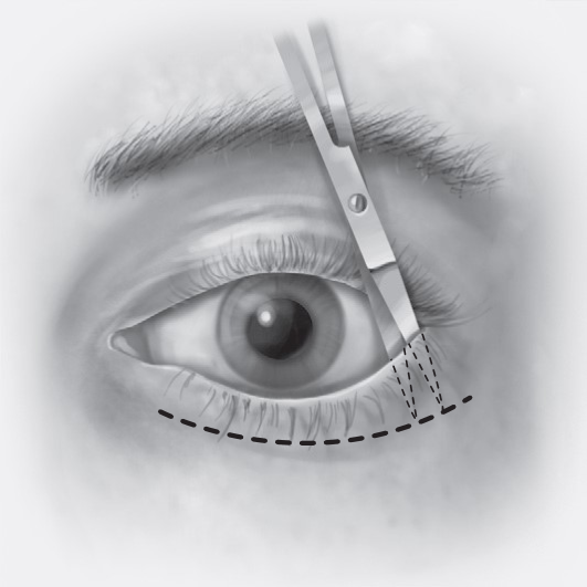FIGURE 16-24 Transconjunctival incisions. A, Retroseptal approach. B, Preseptal approach. C, Initial full-thickness incision through the lateral canthus. D, Inferior cantholysis performed to release the lower eyelid.