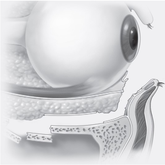 FIGURE 16-24, cont’d E, Conjunctival incision. F, Cross-sectional anatomy of the dissection. G, Canthotomy closure in two layers.