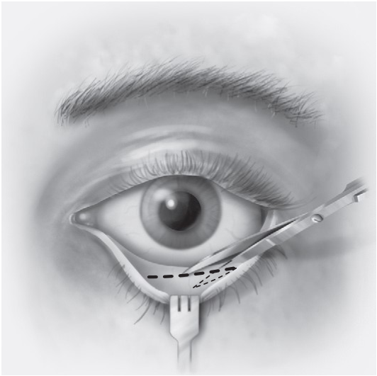 FIGURE 16-24, cont’d E, Conjunctival incision. F, Cross-sectional anatomy of the dissection. G, Canthotomy closure in two layers.
