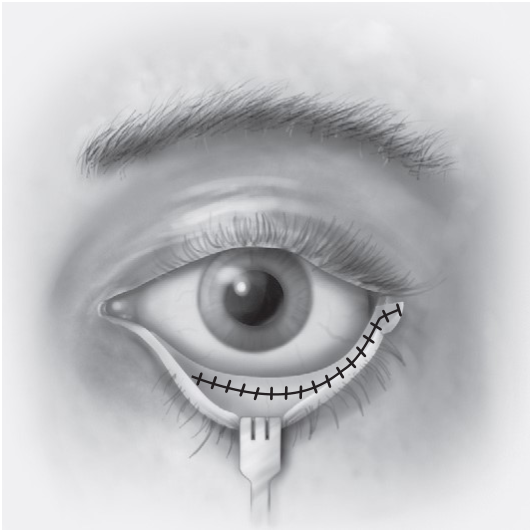 FIGURE 16-24, cont’d E, Conjunctival incision. F, Cross-sectional anatomy of the dissection. G, Canthotomy closure in two layers.