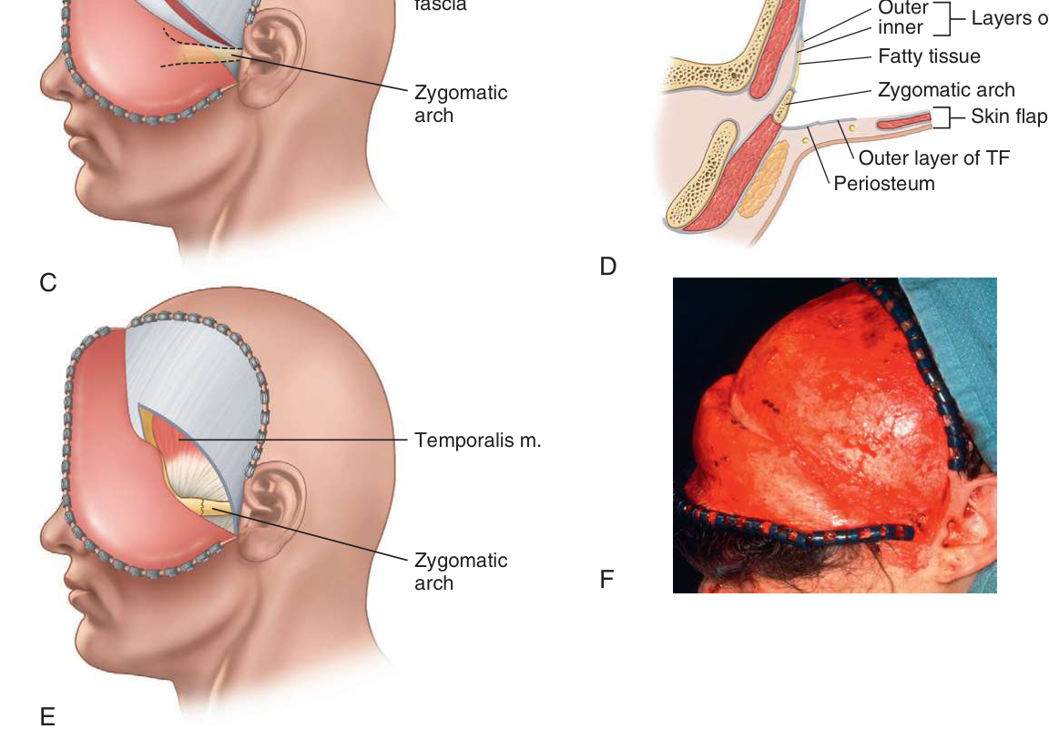 FIGURE 16-25 Coronal incision for exposure of ZMC fracture. A, Location of incision. The incision should be placed well behind the hairline. B, Anatomic layers of scalp and temporal area. C, Dissection of the flap anteriorly above the pericranium and temporal fascia. A second incision is made through the superficial layer of temporalis fascia and pericranium above the supraorbital rim. D, Anatomic layer of dissection through the superficial layer of temporalis fascia. Note that the temporal branch of the facial nerve is retracted laterally, protected by dissection in this plane. E, Subperiosteal dissection of the lateral orbit and zygomatic arch. F, Superficial layer of temporalis fascia is 