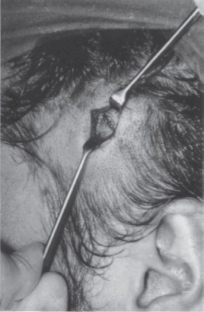 FIGURE 16-26 Gillies temporal approach to elevation of the zygoma. A, Initial incision to the level of the temporalis fascia. B, Second incision through the temporalis fascia to the underlying muscle. Note the muscle, which usually bulges out slightly through the incision. C, A flat periosteal elevator is inserted deep to the temporalis fascia (between the fascia and the muscle) and is swept anteriorly and posteriorly because it is advanced inferiorly. In this manner, the deep surface of the temporalis fascia is freed from the temporalis muscle. The periosteal elevator is advanced inferiorly until the medial surface of the zygomatic arch and temporal surface of the zygomatic body are identif