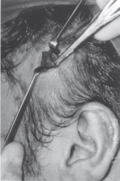 FIGURE 16-26 Gillies temporal approach to elevation of the zygoma. A, Initial incision to the level of the temporalis fascia. B, Second incision through the temporalis fascia to the underlying muscle. Note the muscle, which usually bulges out slightly through the incision. C, A flat periosteal elevator is inserted deep to the temporalis fascia (between the fascia and the muscle) and is swept anteriorly and posteriorly because it is advanced inferiorly. In this manner, the deep surface of the temporalis fascia is freed from the temporalis muscle. The periosteal elevator is advanced inferiorly until the medial surface of the zygomatic arch and temporal surface of the zygomatic body are identif