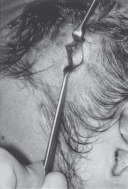 FIGURE 16-26 Gillies temporal approach to elevation of the zygoma. A, Initial incision to the level of the temporalis fascia. B, Second incision through the temporalis fascia to the underlying muscle. Note the muscle, which usually bulges out slightly through the incision. C, A flat periosteal elevator is inserted deep to the temporalis fascia (between the fascia and the muscle) and is swept anteriorly and posteriorly because it is advanced inferiorly. In this manner, the deep surface of the temporalis fascia is freed from the temporalis muscle. The periosteal elevator is advanced inferiorly until the medial surface of the zygomatic arch and temporal surface of the zygomatic body are identif