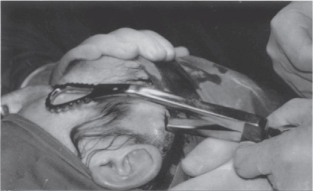 FIGURE 16-26 Gillies temporal approach to elevation of the zygoma. A, Initial incision to the level of the temporalis fascia. B, Second incision through the temporalis fascia to the underlying muscle. Note the muscle, which usually bulges out slightly through the incision. C, A flat periosteal elevator is inserted deep to the temporalis fascia (between the fascia and the muscle) and is swept anteriorly and posteriorly because it is advanced inferiorly. In this manner, the deep surface of the temporalis fascia is freed from the temporalis muscle. The periosteal elevator is advanced inferiorly until the medial surface of the zygomatic arch and temporal surface of the zygomatic body are identif