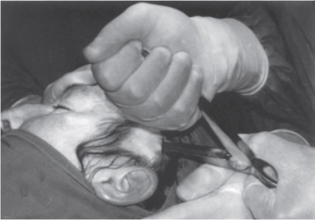 FIGURE 16-26 Gillies temporal approach to elevation of the zygoma. A, Initial incision to the level of the temporalis fascia. B, Second incision through the temporalis fascia to the underlying muscle. Note the muscle, which usually bulges out slightly through the incision. C, A flat periosteal elevator is inserted deep to the temporalis fascia (between the fascia and the muscle) and is swept anteriorly and posteriorly because it is advanced inferiorly. In this manner, the deep surface of the temporalis fascia is freed from the temporalis muscle. The periosteal elevator is advanced inferiorly until the medial surface of the zygomatic arch and temporal surface of the zygomatic body are identif