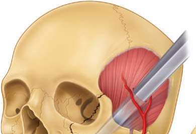 FIGURE 16-26 Gillies temporal approach to elevation of the zygoma. A, Initial incision to the level of the temporalis fascia. B, Second incision through the temporalis fascia to the underlying muscle. Note the muscle, which usually bulges out slightly through the incision. C, A flat periosteal elevator is inserted deep to the temporalis fascia (between the fascia and the muscle) and is swept anteriorly and posteriorly because it is advanced inferiorly. In this manner, the deep surface of the temporalis fascia is freed from the temporalis muscle. The periosteal elevator is advanced inferiorly until the medial surface of the zygomatic arch and temporal surface of the zygomatic body are identif