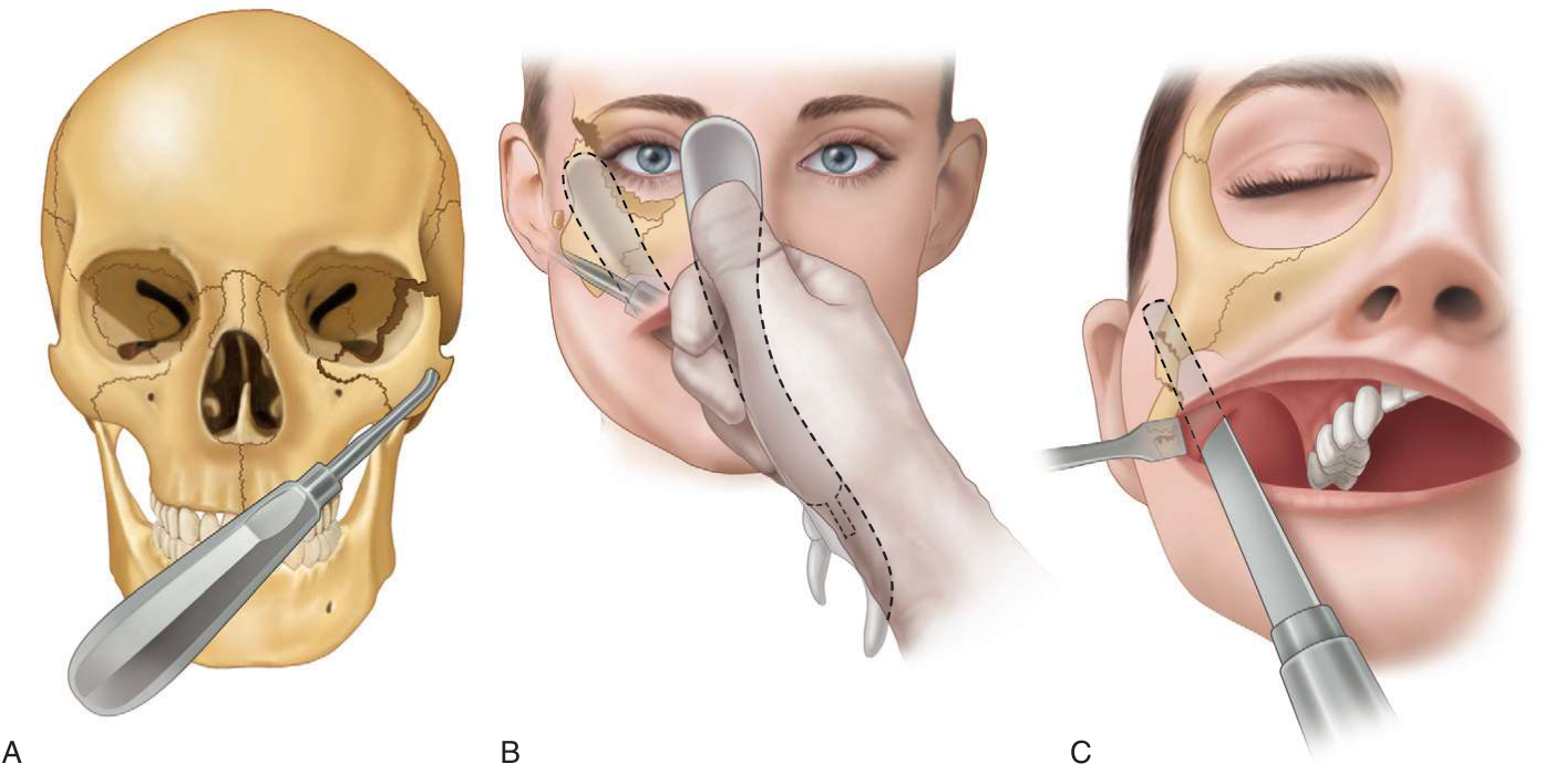 FIGURE 16-27 Intraoral approach to reduction of the ZMC and arch. A, Suitable elevator inserted on the temporal surface of the zygomatic body for elevation. B, Dental extraction forceps used in a manner similar to that for the Rowe zygomatic elevator. C, Flat instrument used to reduce a depressed zygomatic arch.