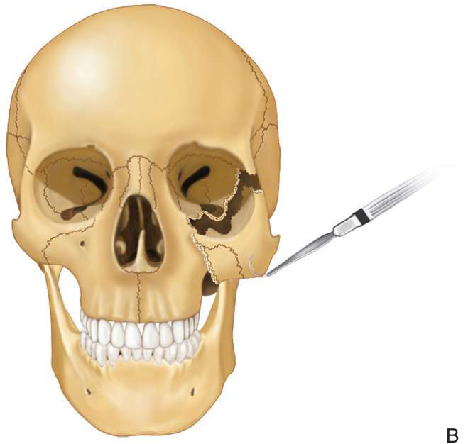 FIGURE 16-29 Elevation of the ZMC with a bone hook. A, Bone hook. B, Anterior and lateral traction with the use of a percutaneous bone hook. C, Clinical photograph of the use of a bone hook. The dotted lines on the face represent those discussed in the text. Note finger placement at the infraorbital rim during elevation to detect reduction.