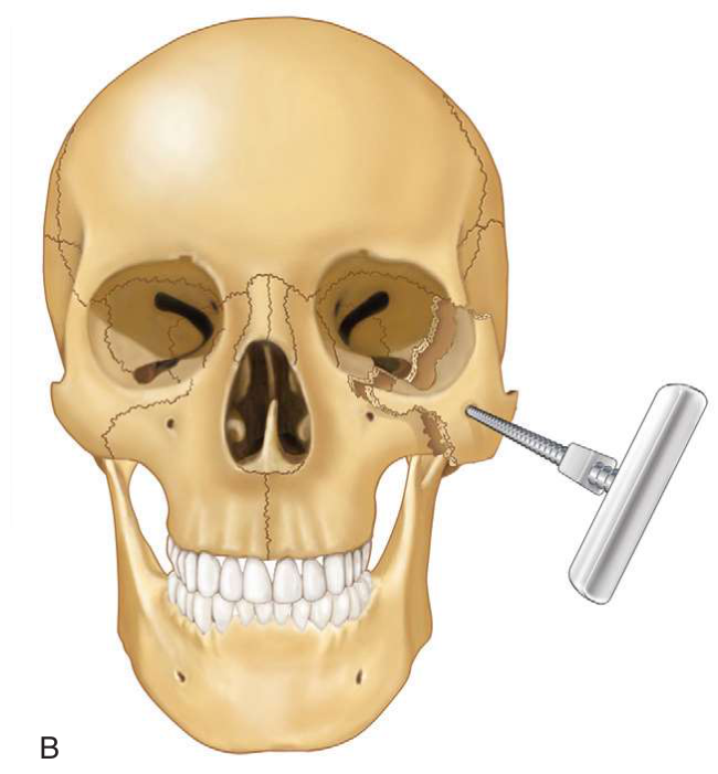 FIGURE 16-30 Elevation of the ZMC with a bone screw inserted percutaneously. A, Carroll-Girard bone screw. B, Use of a bone screw.