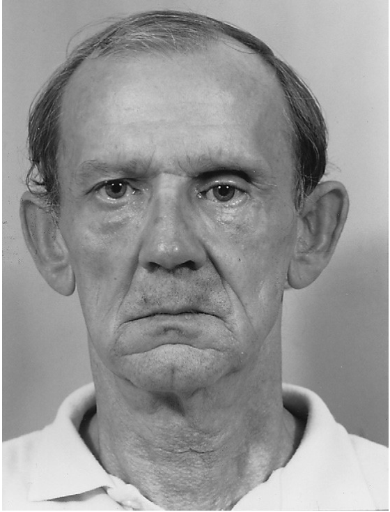 FIGURE 16-32 Patient 8 months after treatment of a left ZMC fracture. Note the deepening of the supratarsal fold, a hallmark of enophthalmos. The slightly inferior position of the globe is also evident.