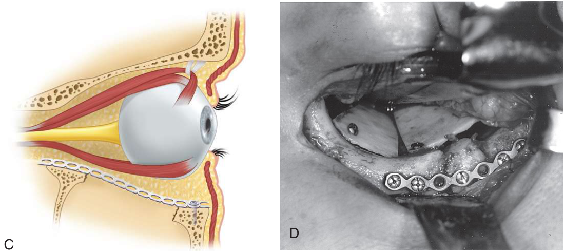 FIGURE 16-33 A, Right ZMC fracture with comminution of the orbital floor and medial wall. B, After reduction and internal fixation of the ZMC fracture, the internal orbit is reconstructed with a graft or implant that completely bridges the defect or comminuted area. C, Stabilization of the graft or implant is performed with a lag screw or by other means. D, Reconstruction of the left orbital floor and medial wall with the use of calvarial bone grafts secured with lag screws.