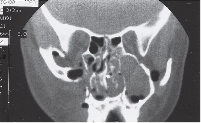FIGURE 16-34 A, Patient sustained severe (high-energy) right ZMC and internal orbital fractures. B, Axial CT scan through the zygomatic arch shows retrusion of the entire ZMC and fracture of the arch at the junction with the articular eminence of the temporal bone. C, Axial CT scan showing posterior displacement of the ZMC. D, Coronal CT scan behind the globe showing disruption of the floor. E, Coronal exposure demonstrating reconstruction of the zygomatic arch and bone plate at the frontozygomatic suture area. F, After stabilizing the ZMC in position, a large orbital floor defect is present, with only the infraorbital nerve spanning it.