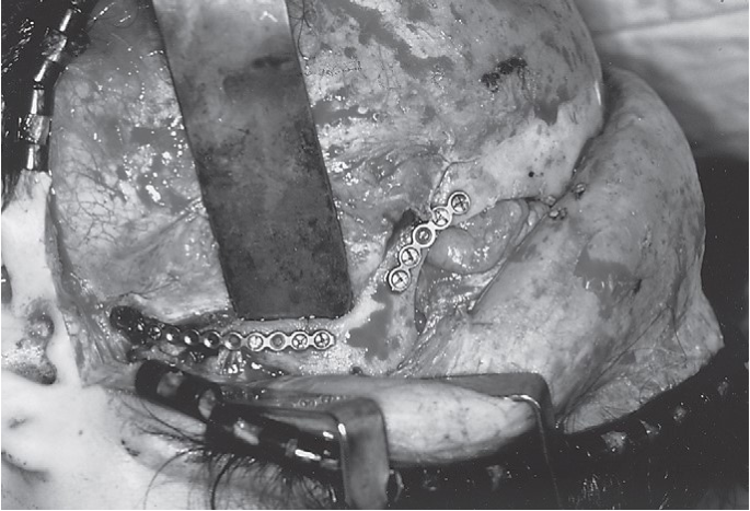 FIGURE 16-34 A, Patient sustained severe (high-energy) right ZMC and internal orbital fractures. B, Axial CT scan through the zygomatic arch shows retrusion of the entire ZMC and fracture of the arch at the junction with the articular eminence of the temporal bone. C, Axial CT scan showing posterior displacement of the ZMC. D, Coronal CT scan behind the globe showing disruption of the floor. E, Coronal exposure demonstrating reconstruction of the zygomatic arch and bone plate at the frontozygomatic suture area. F, After stabilizing the ZMC in position, a large orbital floor defect is present, with only the infraorbital nerve spanning it.